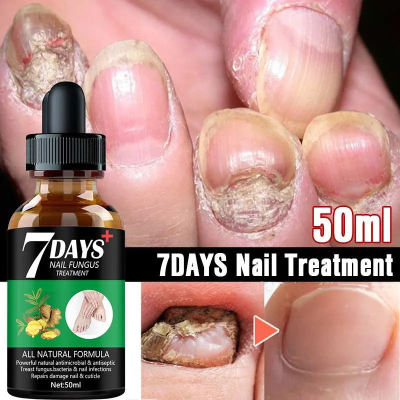 Nuomez - Natural Nail Fungus Treatment Serum