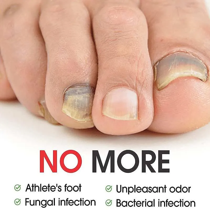 Nuomez - Natural Nail Fungus Treatment Serum