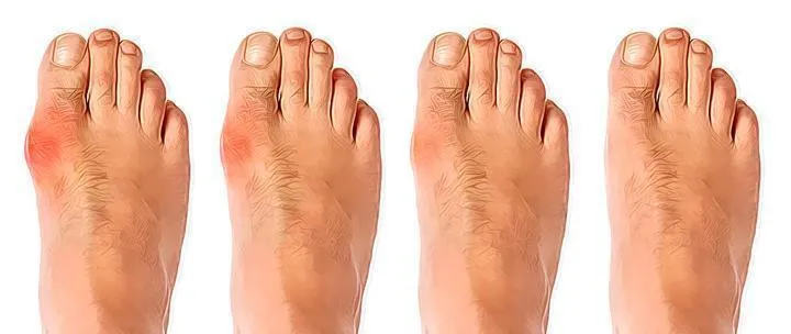 The Bunion Relief and Forefoot Protector Brace "Pair"